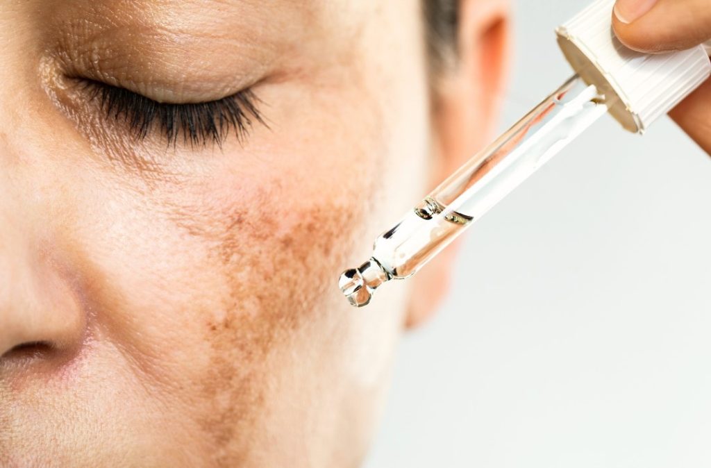 hyperpigmentation featured image