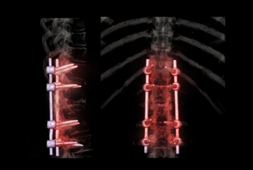 spinal fusion surgery