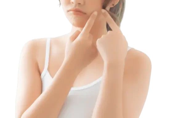 Adult Acne