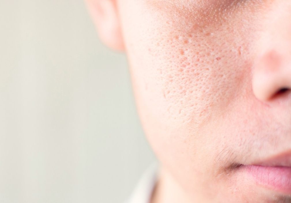 enlarged pores featured image