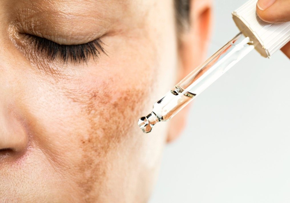hyperpigmentation featured image